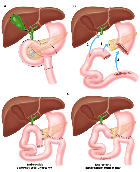 Figura 1. Cirugía de Whipple (Pancreatoduodenectomía convencional)6.